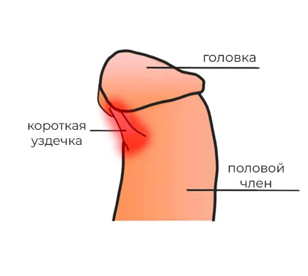 Короткая уздечка полового члена — причины, диагностика и пластика уздечки в АМ Медика